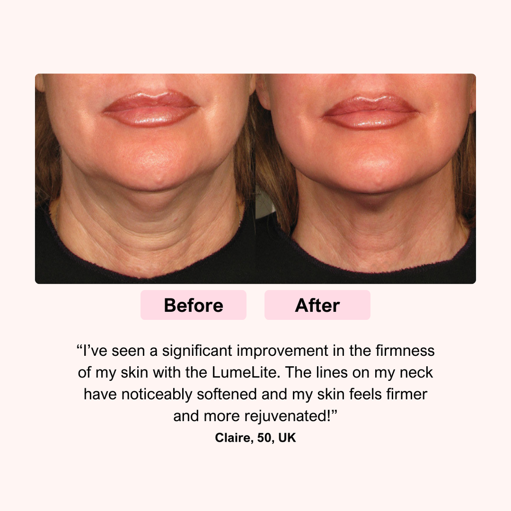 LUNA&SKIN LumeLite™