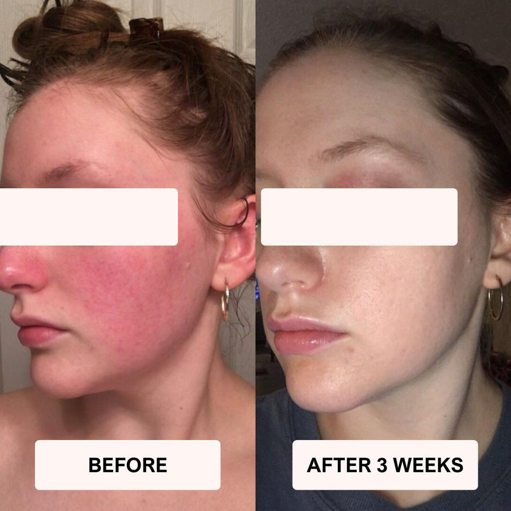 LUNA&SKIN RegenMask™